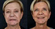 A before and after image of a woman who received Radiesse neck treatment at Aesthetics IQ.