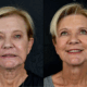 A before and after image of a woman who received Radiesse neck treatment at Aesthetics IQ.