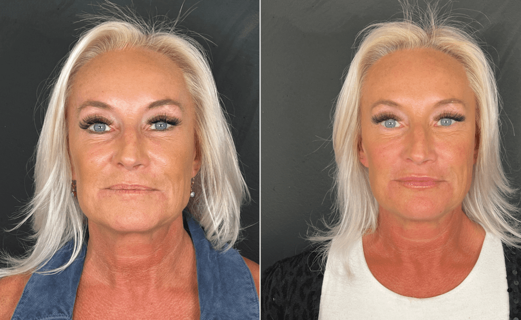 A before and after biostimulator treatment showing smoother skin texture and improved facial firmness on an Aesthetic IQ woman patient.