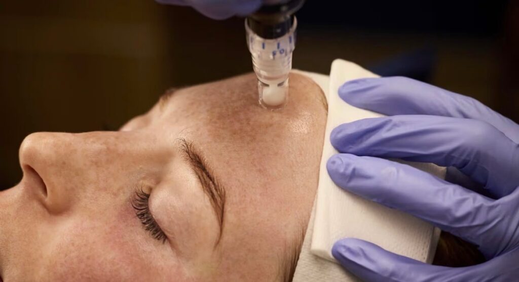 A patient receives a facial injectable treatment on the forehead while undergoing a preventative skincare procedure.